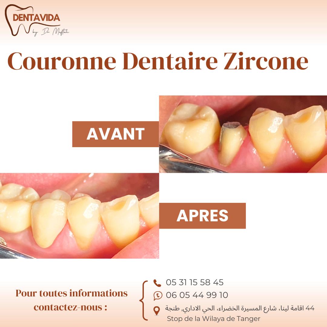 couronne dentaire zircone tanger