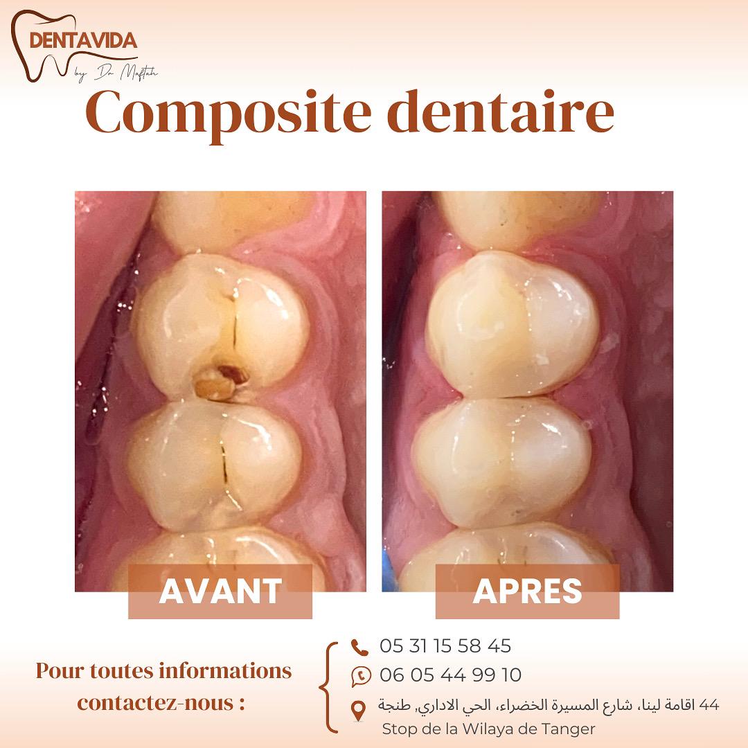 dentiste composite dentaire tanger