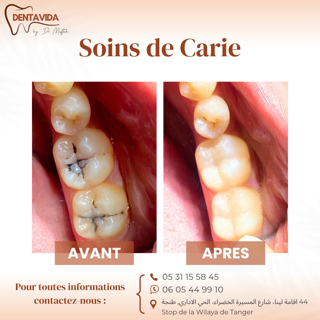 dentiste soins de carie tanger