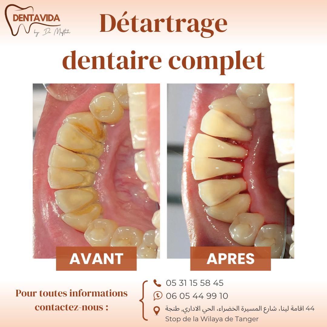 détartrage dentaire à tanger