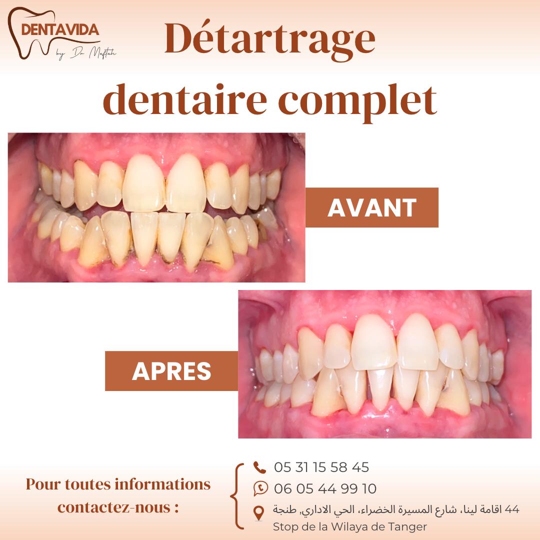 détartrage dentaire tanger