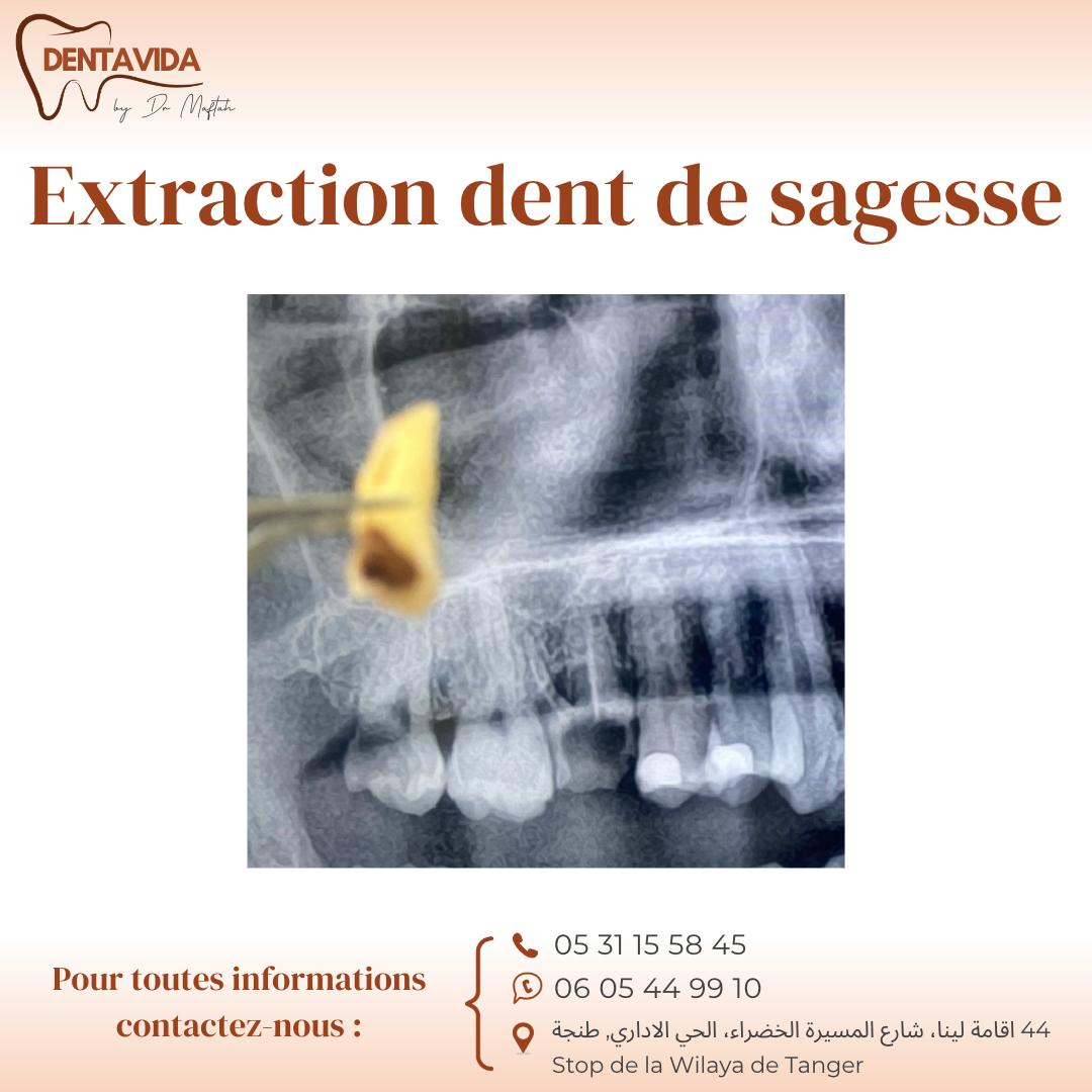 extraction dent de sagesse à tanger