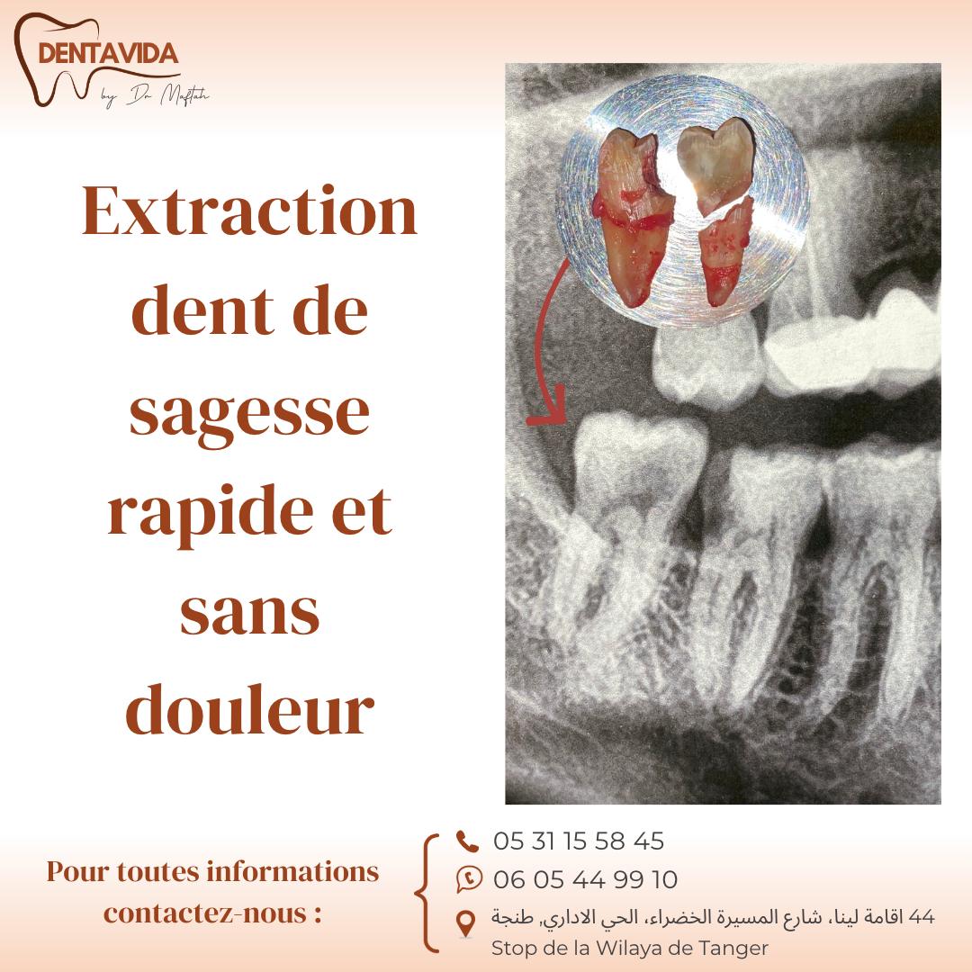 extraction dent de sagesse tanger