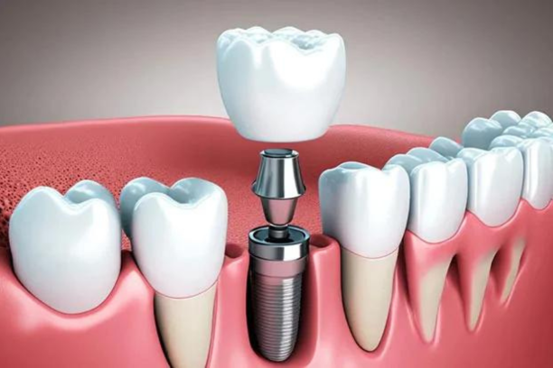 implants dentaire tanger