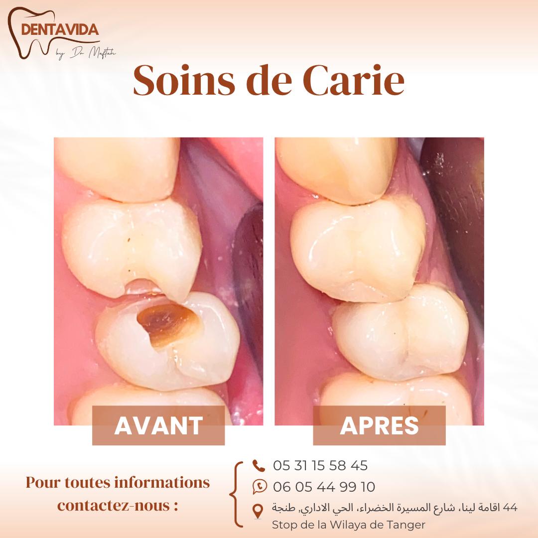 meilleur soins de carie tanger