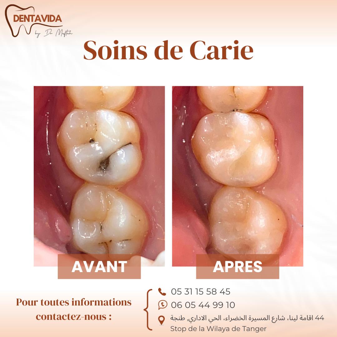 soins de carie tanger