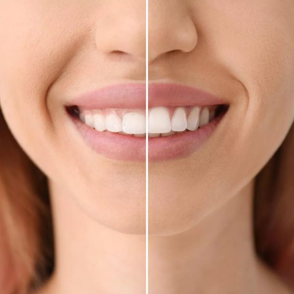 Contournement Gingival tanger