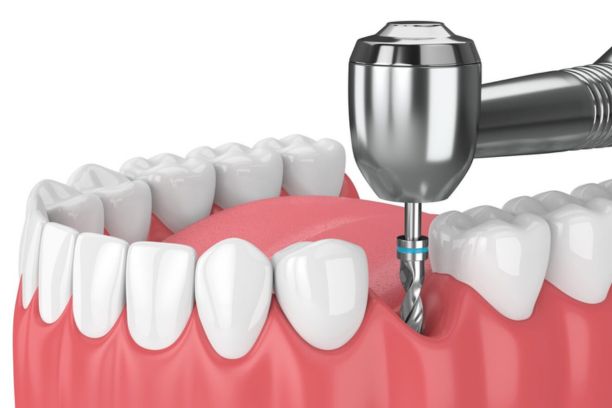 implant dentaires à Tanger