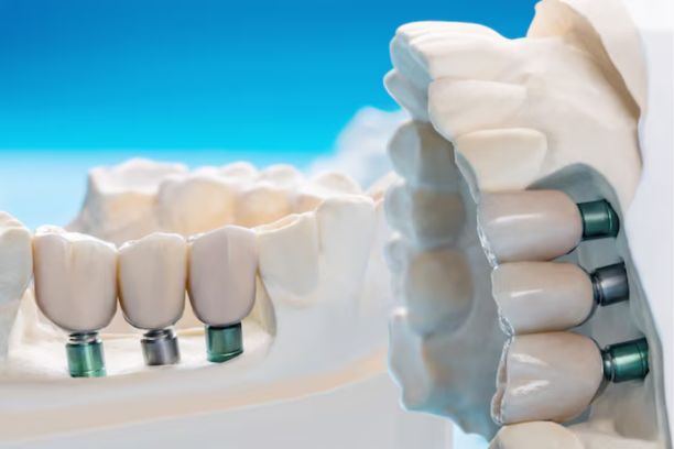 implants dentaires Tanger