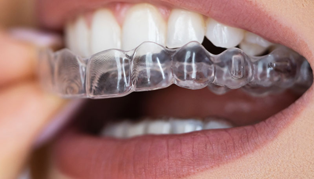 Aligneurs dentaires esthetique pour redresser les dents et redonner la vie au sourire.